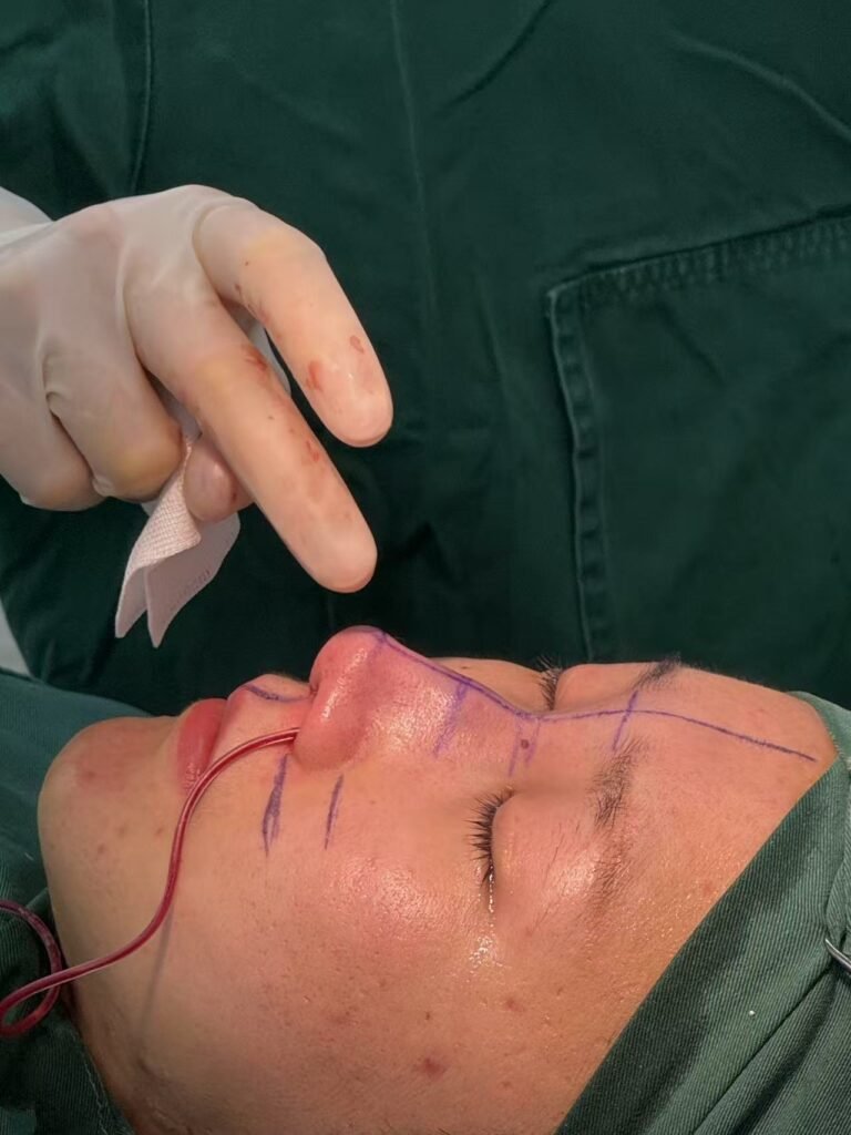 Open Rhinoplasty คือ เทคนิคศัลยกรรมจมูกที่เปิดทางให้แพทย์เห็นทุกโครงสร้าง ปรับแก้ได้ละเอียดที่สุด เหมาะกับเคสยากหรือผู้ที่ต้องการผลลัพธ์แม่นยำ
