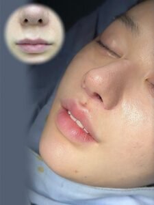 ทำศัลยกรรมปากแมว
