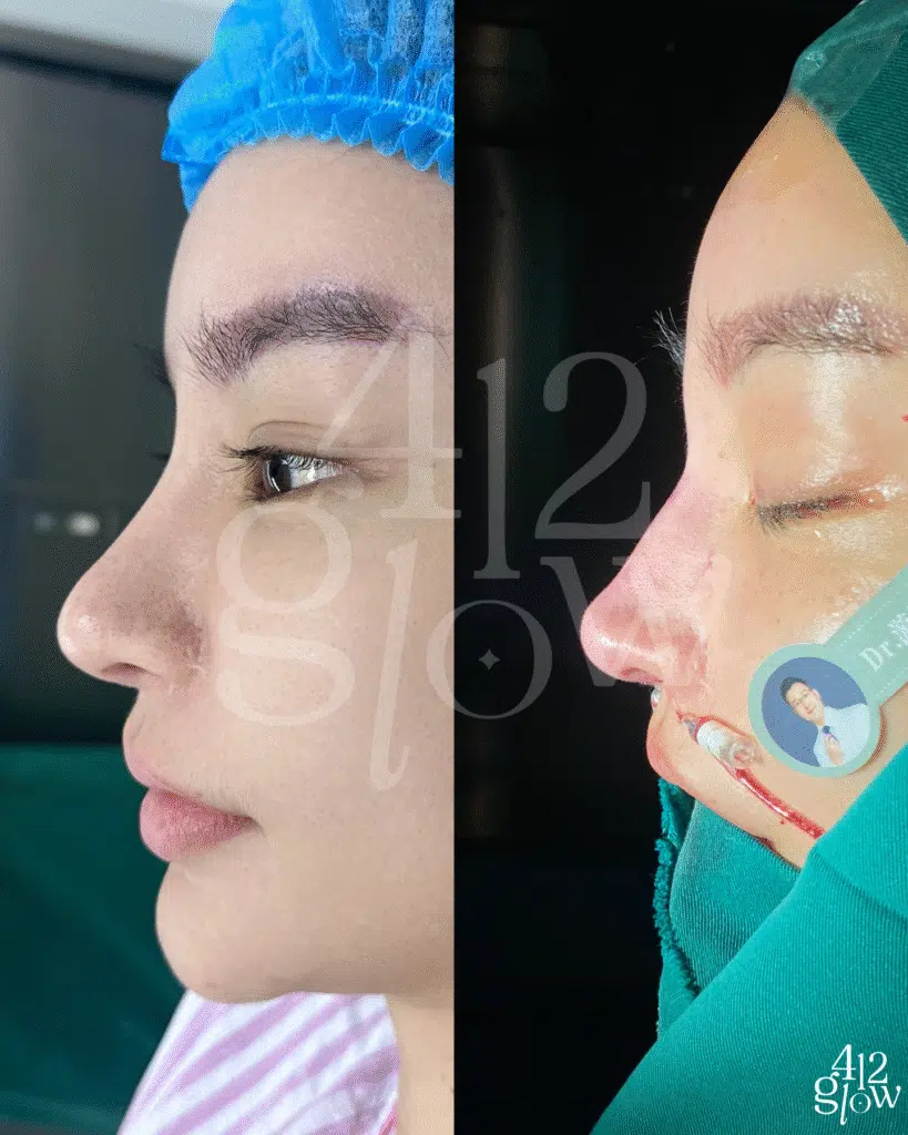 รีวิวทำจมูก นิวนิวเอวเด้ง กับ 412glow