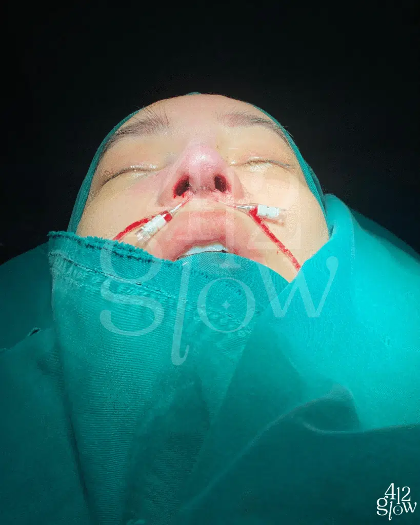 รีวิวจมูก นิวนิวเอวเด้ง หลังทำ