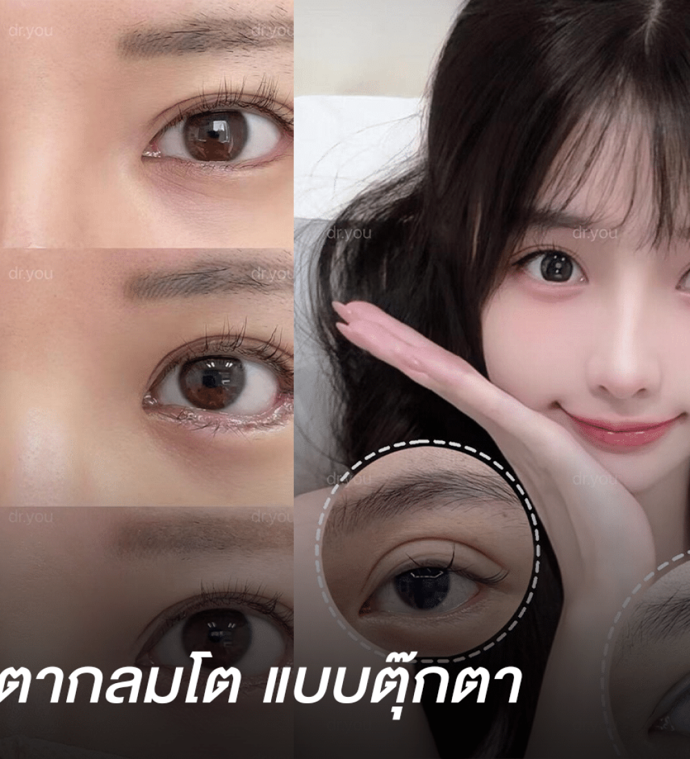 ทำตา full option ศัลยกรรมจีน ที่ 412GLOW