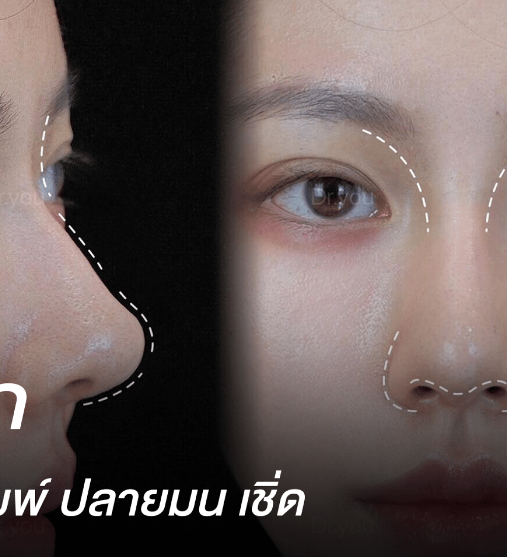 รีวิวทำจมูกแบบมีฮัมพ์ ทรงพี่สาวยจีน